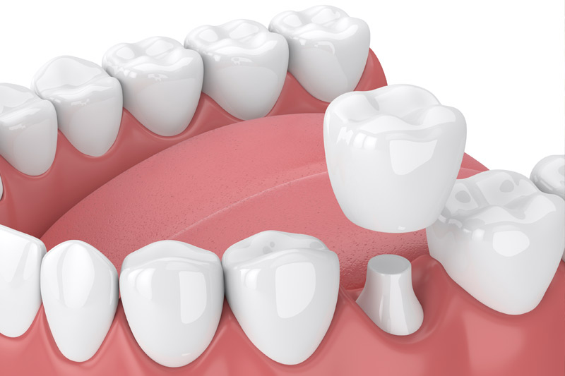 Dental Crowns in Pennsauken