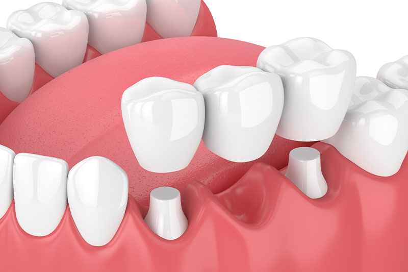 Dental Bridges in Pennsauken