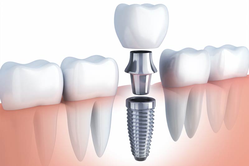 Implants Dentist in Pennsauken