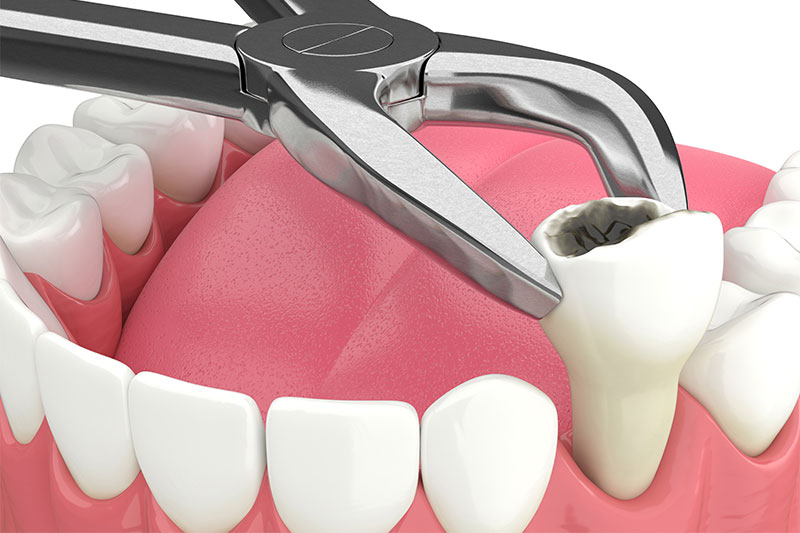 Tooth Extraction in Pennsauken